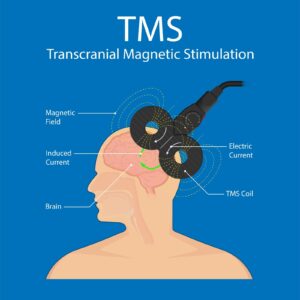 TMS
